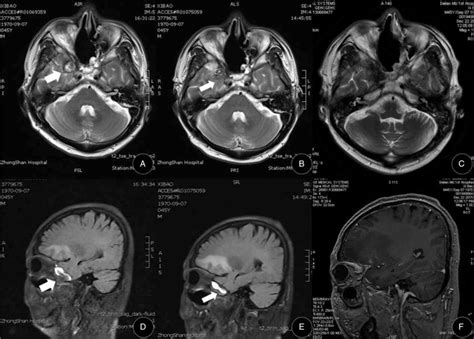 A And D Enhancement Cerebral Magnetic Resonance Imaging MRI Showing