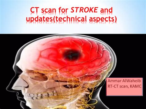 ct scan   brain  stroke patients pptx