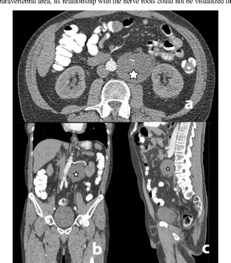 Figure From Giant Retroperitoneal Schwannoma Removed With The