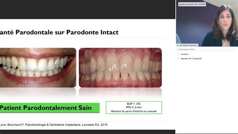 Nouvelle Classification Des Maladies Parodontales Quels Diagnostics