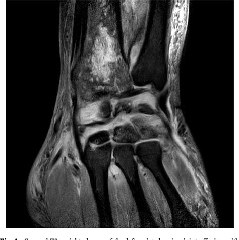 Figure 1 From Septic Arthritis And Osteomyelitis Due To Roseomonas