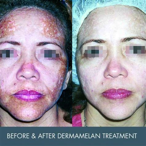 Dermamelan Perth | Academy Face & Body Cosmetic Clinic