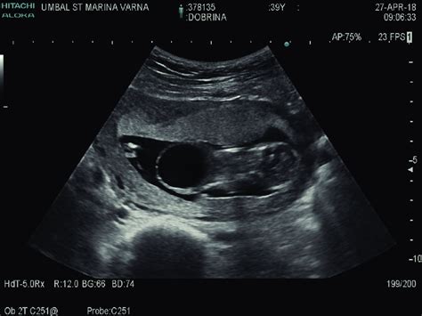 Ultrasonography. Distended urinary bladder wall and distended abdominal... | Download Scientific ...