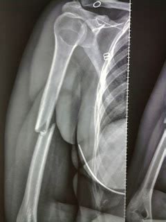 Nuestro esqueleto Miembro superior Fracturas de diáfisis humeral