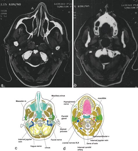 Axial Ct Neck Anatomy