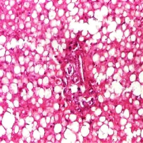 Steatohepatitis Displaying Ballooning Degeneration And Steatosis He