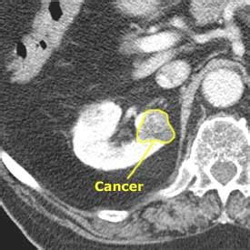 Comprehensive Cancer Information: Kidney Cancer - Causes, Symptoms and ...