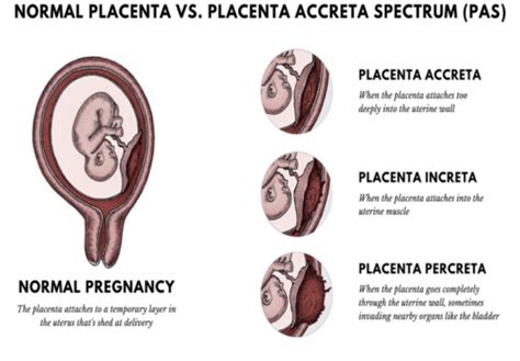 Causes Of Bleeding In Pregnancy And Placental Problems Flashcards Quizlet