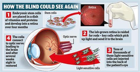 Could Cell Transplant Give Sight To Millions Scientists Grow Retinas