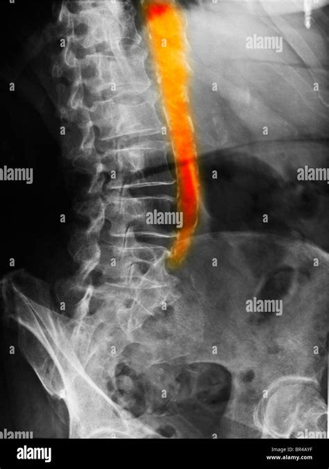 Abdomen X Ray Of An 80 Year Old Female Showing A Calcified Aorta From