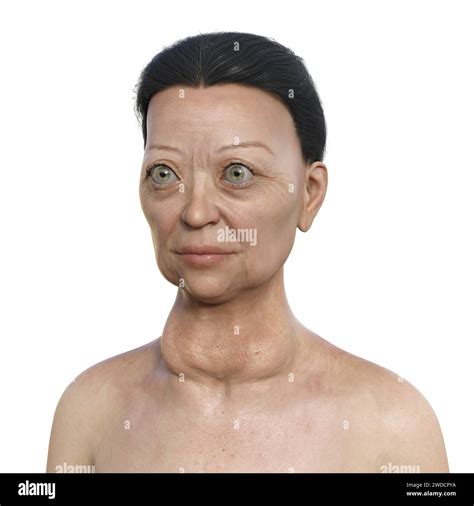 Illustration Depicting A Woman With Graves Disease Showing An Enlarged