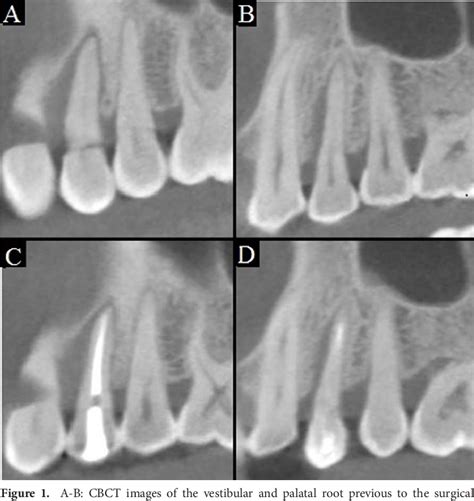 Figure From Treatment Of Endo Periodontal Lesion Using Leukocyte