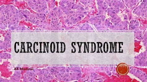 Carcinoid Syndrome Pathophysiology Symptoms Diagnosis And Treatment