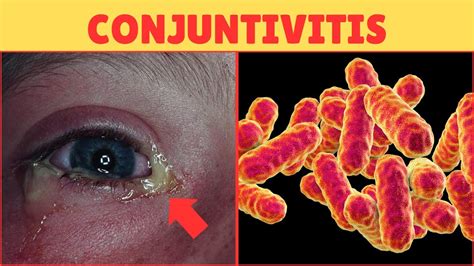 Alerta🚨 Conjuntivitis Bacteriana Y Viral Sintomas Y Tratamiento Youtube