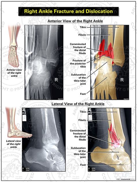 Right Ankle Fracture And Dislocation