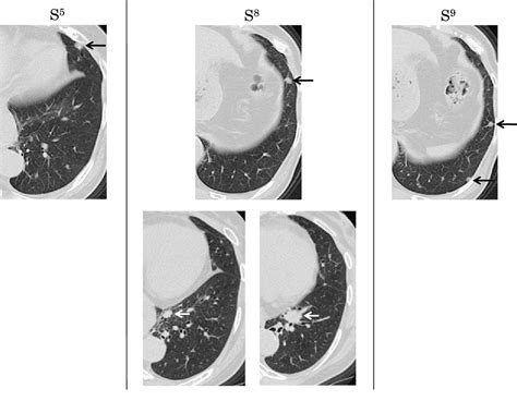 Figure 2 From A Case Of Primary Lung Cancer With Multiple Intrapulmonary Lymph Node Metastases