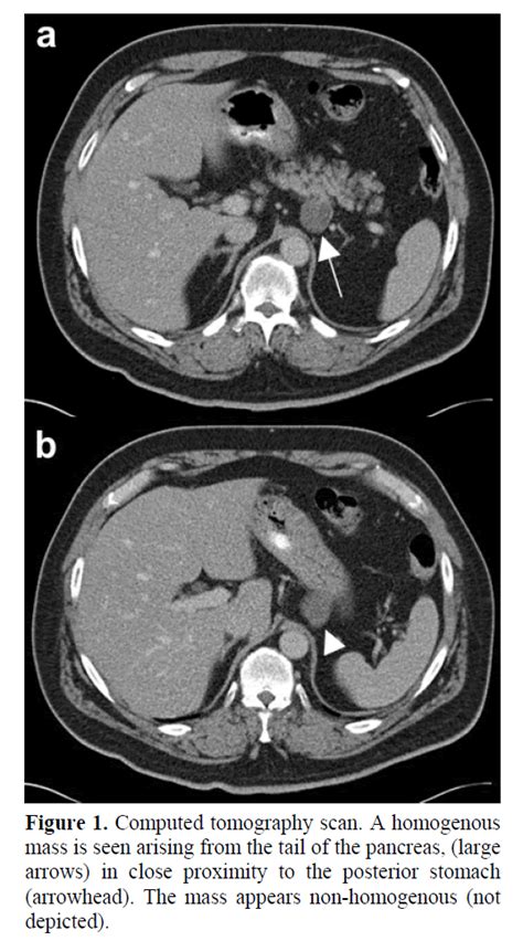 Cystic Teratoma Of The Pancreas Presentation Evaluation And Man