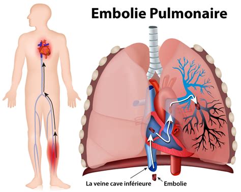 Lembolie pulmonaire Association pulmonaire du Québec