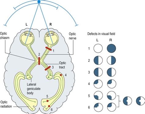 Disturbances of vision | Clinical Gate