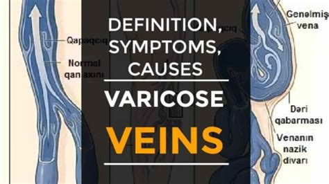 Varicose Veins Definition 6 Symptoms Causes Risk Factors