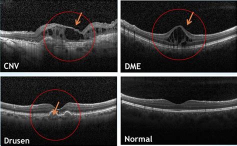 Normal Macular Oct