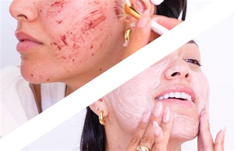 Fade Dark Spots And Hyperpigmentation Faster With This Step Method