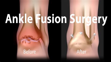 Ankle Fusion Surgery Animation Youtube