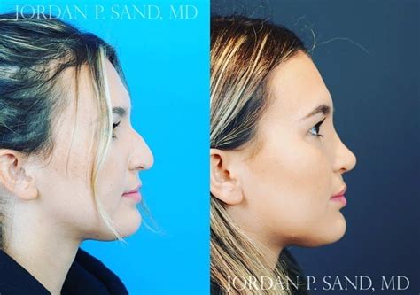 Rhinoplasty And Scar Revision 1 Sand Plastic Surgery Of Spokane