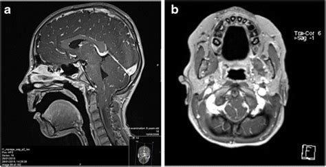 a–b Mid-sagittal T1-weighted MRI of the brain shows tonsillar ...