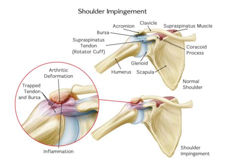 Shoulder Bursitis - Physiotherapist Brisbane City, Physio Therapy