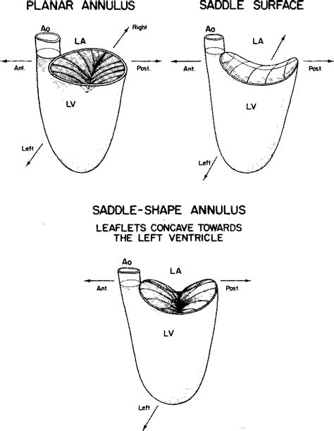 Figure 2 From MITRAL VALVE PROLAPSE The Relationship Of Mitral Annular