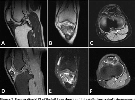 Figure 2 From Multiple Nodular Form Of Localized Pigmented Villonodular