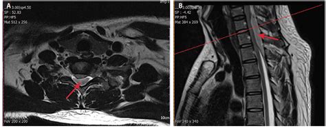 Case Report Complete Spinal Cord Injury Practical Neurology