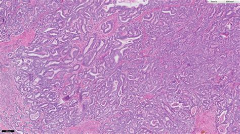 Cholangiocarcinoma Histology