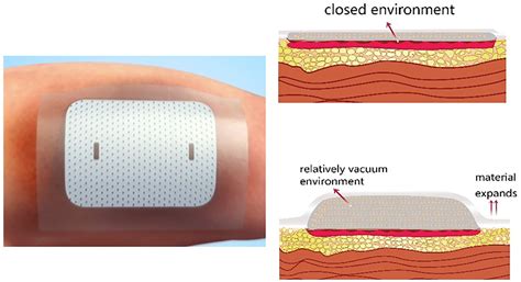 What Is In A Pressure Dressing At Edwin Love Blog