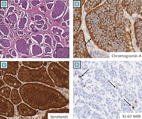 Ec Cell Ileal Well Differentiated Neuroendocrine Tumor A The Tumor Download Scientific