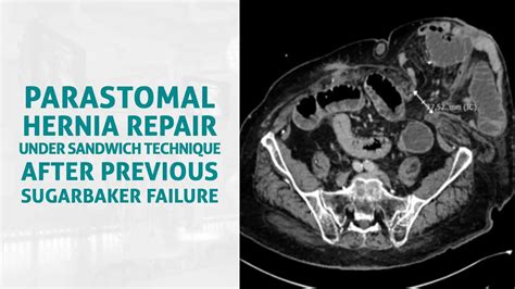 Ais Channel Parastomal Hernia Repair Under Sandwich Technique After