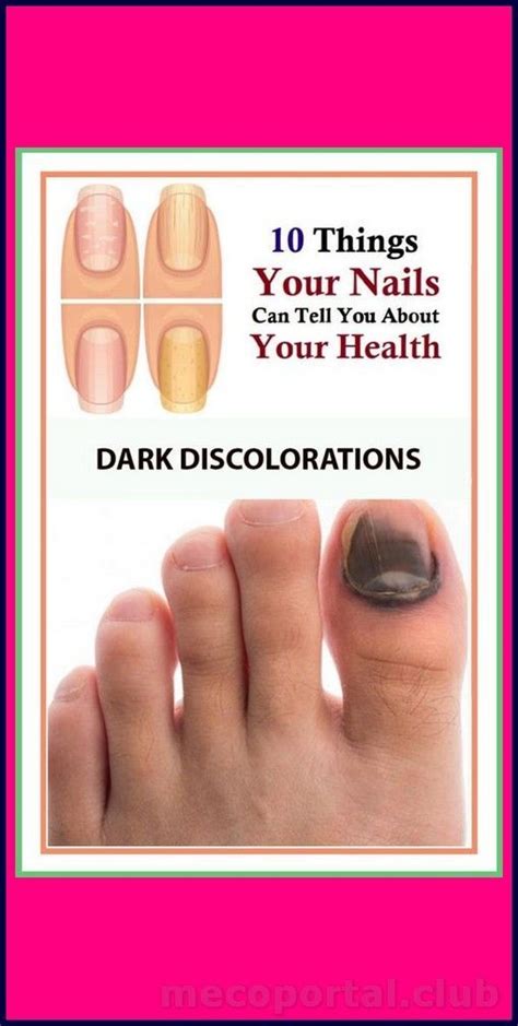 8 Important Signs Your Fingernails Can Tell About Your Health Artofit