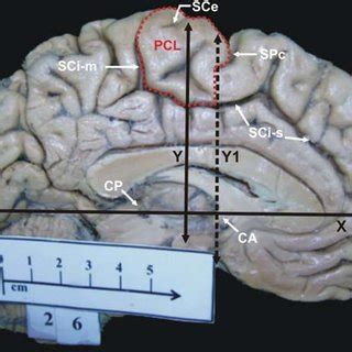 Paracentral lobule (PCL)segmented type (segmented by deep sulcus into ...