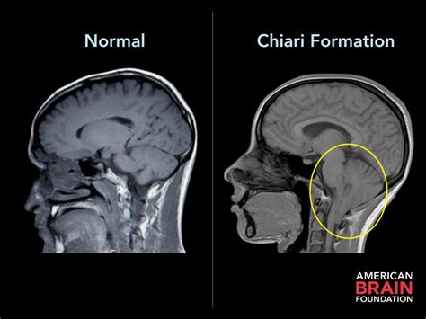 Chiari Decompression