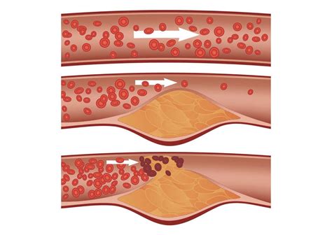 HDL Cholesterol: What Is HDL Cholesterol?