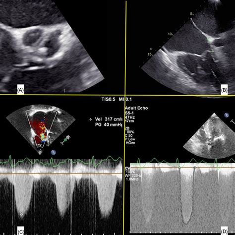 Preoperative Echocardiography A Transesophageal Echocardiography Download Scientific Diagram