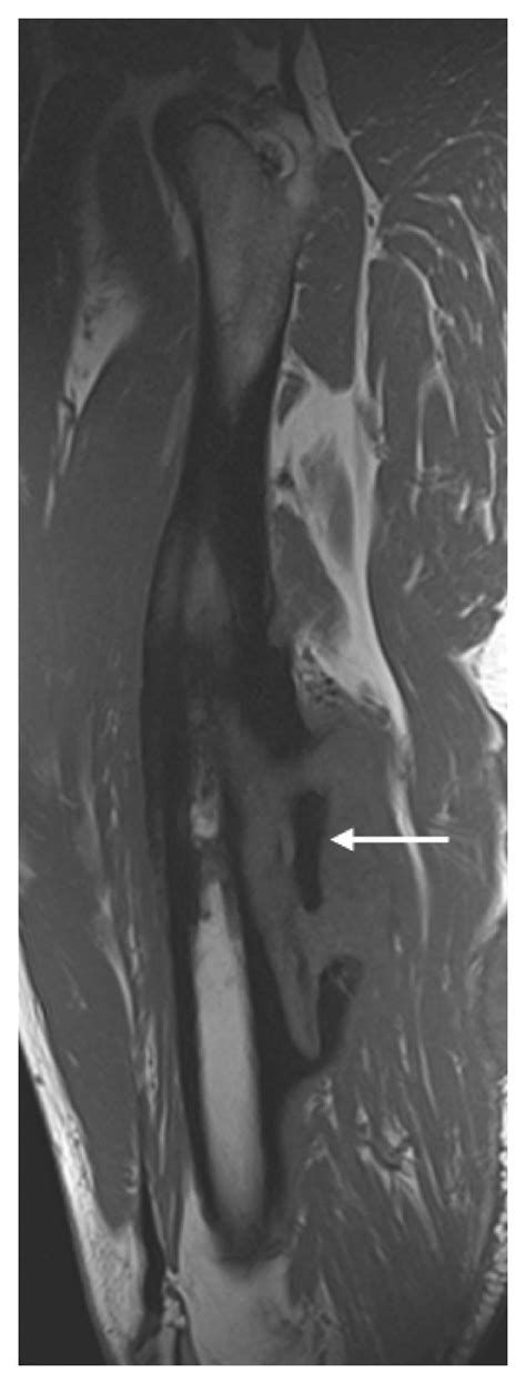 A 30 Year Old Systemically Well Man With Chronic Osteomyelitis Who