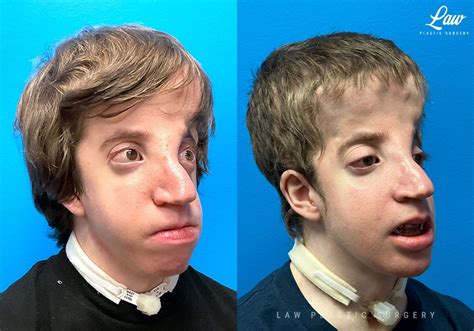 Craniofacial Reconstruction Before & After Photos - Law Plastic Surgery