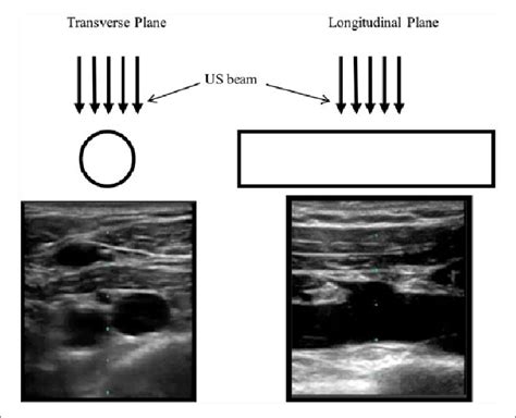 Longitudinal Vs Transverse Ultrasound