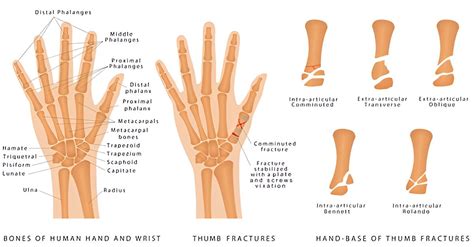 understanding hand fractures types symptoms  treatment options