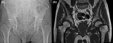 Computed Tomography Based Diagnosis Of Occult Fragility Hip Fractures