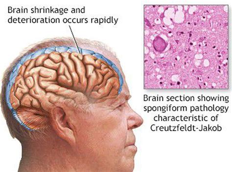 Болезнь крейтцфельдта якоба картинки