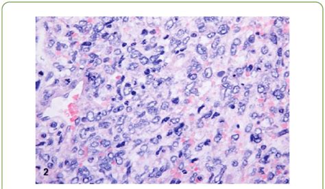 Pleomorphic Cells With Numerous Hyperchromatic Nuclei Download