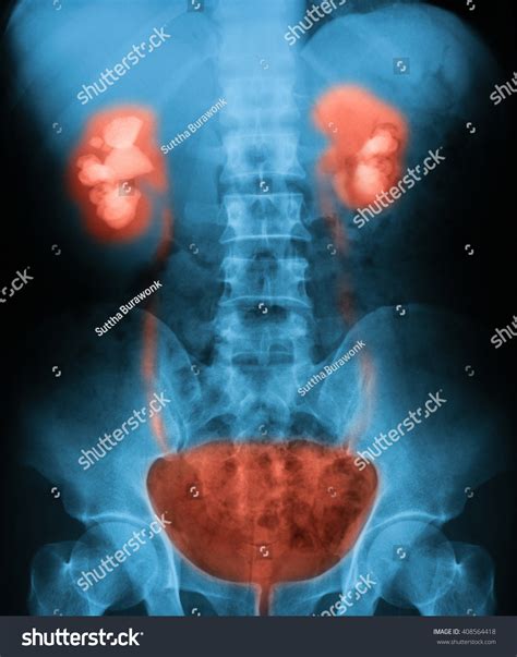 X Ray Image Of Plain Kub Kidney Ureter And Bladder Showing Stones